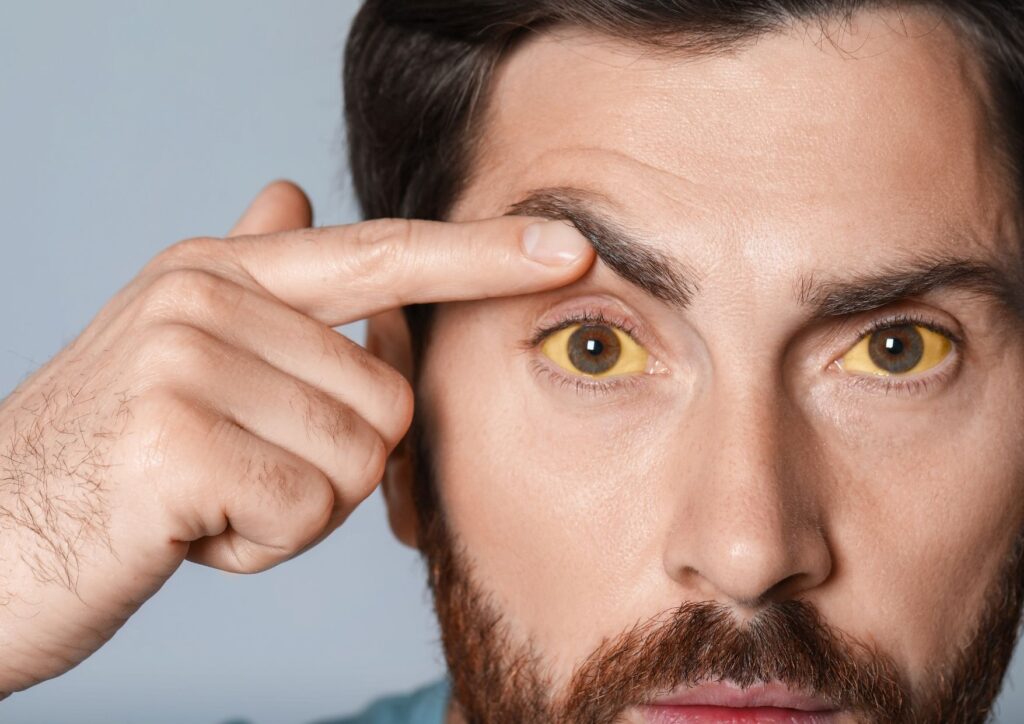 Eye-related symptoms of fatty liver