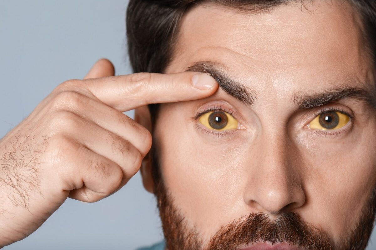 Eye-related symptoms of fatty liver